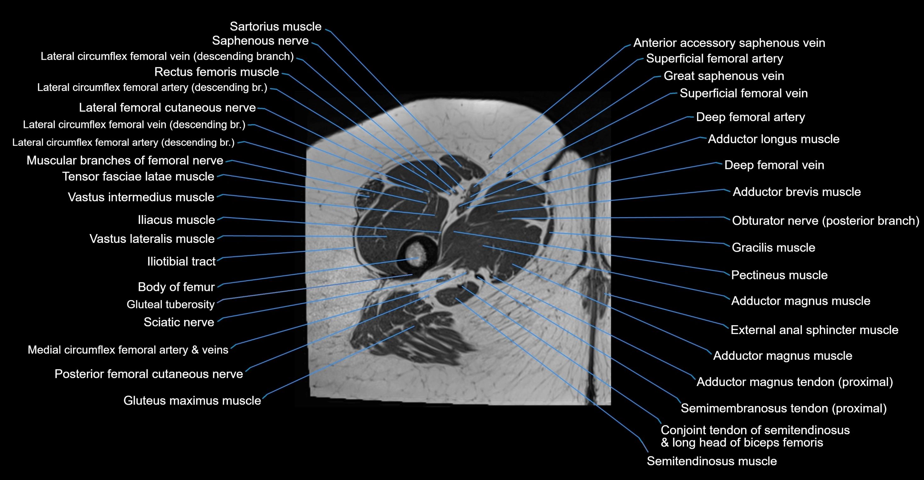 MRI hip axial cross sectional anatomy 3T 3D  radiology  anatomy image-img-00001-00082.webp